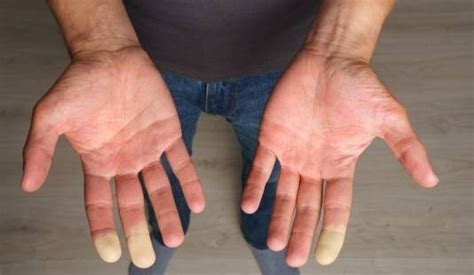 Syndrome De Raynaud Les Causes Et Les Traitements Conseil Pharmacien