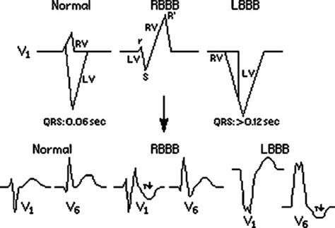 Cardiac Resynchronization Therapy History Present Status And Future