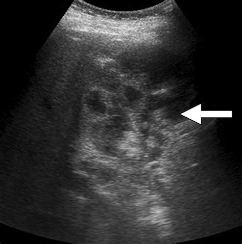 Imaging Of Cholecystitis Ajr