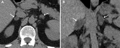 Incidentally Detected Bilateral Adrenal Adenomas Axial Non Enhanced Ct