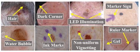 Diagnostics Free Full Text Skin Cancer Detection Using Deep