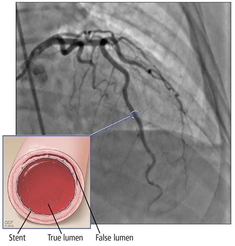 Spontaneous Coronary Artery Dissection An Often Unrecognized Cause Of