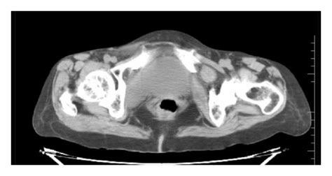 Ct Scan Of Lower Pelvis And Inguinal Region Showing Herniation Of Small