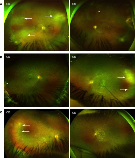 Acute Retinal Necrosis From Herpes Simplex Virus Type 2 A Case Series