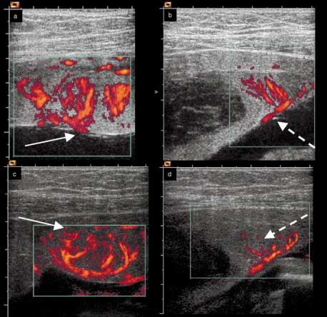 Power Doppler Imaging For Quantitative Analysis At Weeks A B And