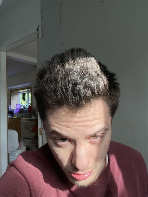 9 Months On Finasteride And Minoxidil Results Hair Feels Much Better