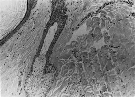 Dermoid Cyst Of The Testis Annals Of Saudi Medicine