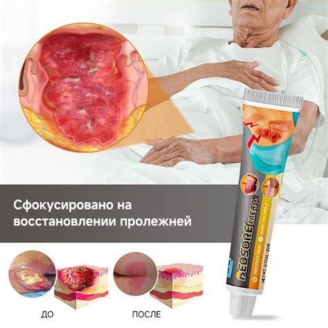 Мазь от пролежней/заживляющий гель для ран и ожогов/для лечения ран ...