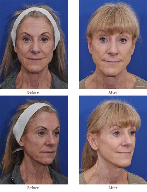 LIFE Before and After Photos | Mini-Facelift