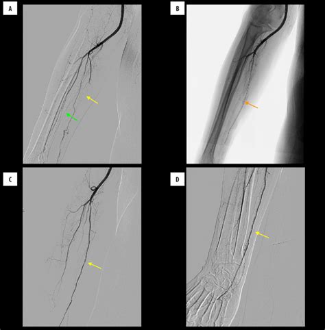 Endovascular recanalization of ulnar artery occlusion. Arteriography... | Download Scientific ...