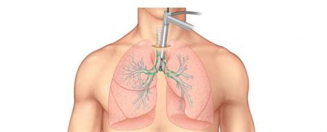 Mediastinoscopy Koç Healthcare