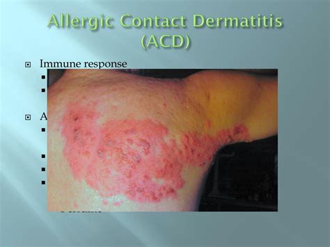 Ppt Contact Dermatitis Powerpoint Presentation Free Download Id 4317307