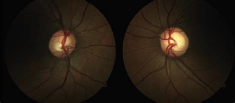 Optic Nerve Glaucoma