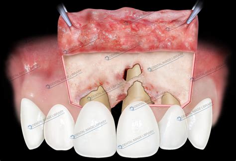 Dehiscence and fenestration in maxillary incisor. 101JB00095 | Dental ...