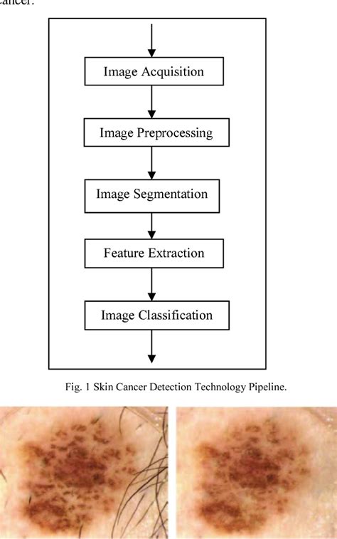 Research On Skin Cancer Cell Detection Using Image Processing