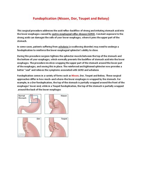 Fundoplication (Nissen, Dor, Toupet and Belsey) | PDF