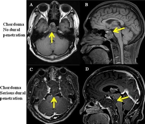 Mri Of Clival Chordoma Patients With No Dural Penetration And With