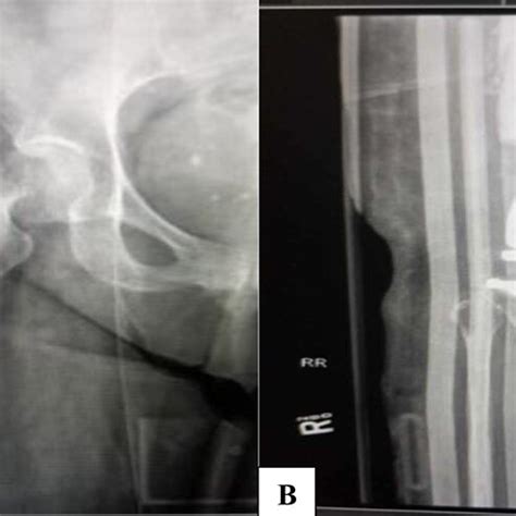 (A) Pre-Operative radiograph showing a Garden 4 subcapital fracture of ...