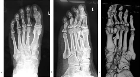 Treatment Of Fractures Of Metatarsal Shaft Using A Cemented K Wire