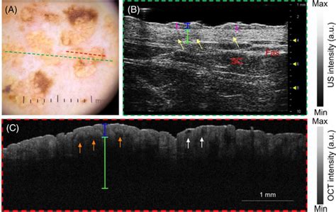 Nevus Sebaceous Ns Of Phacomatosis Pigmentokeratotica Ppk On The