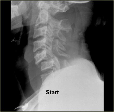 Cervical spine fracture x rays - isseplum