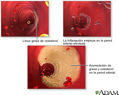 Acumulaci N De Placa Arterial Medlineplus Enciclopedia M Dica Illustraci N