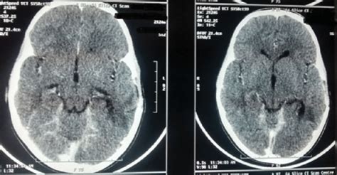 Postoperative Contrast Enhanced Computed Tomography Showing