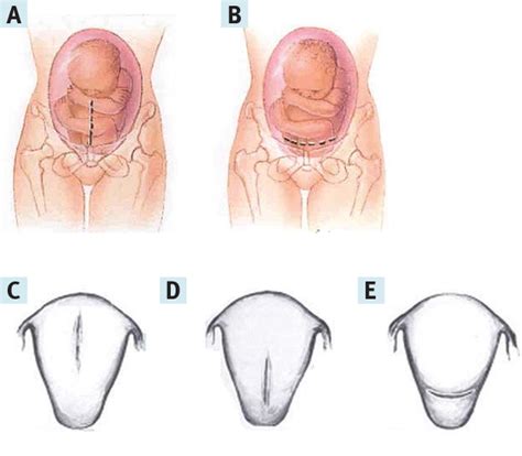 Figure 1 from The History of the Low Transverse Cesarean Section: The Pivotal Role of Munro Kerr ...