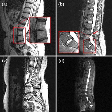 Examples of failure cases. a Fused vertebral bodies (L3 and L4). b ...