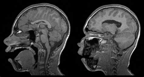 Lissencephaly2