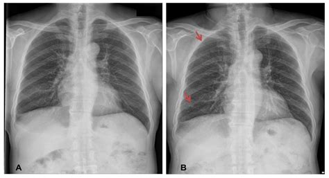 Lung Cancer Chest X Ray