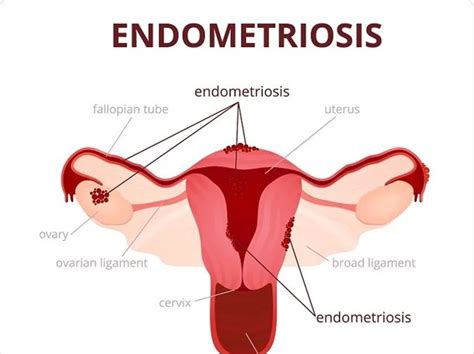 Endometriosis Teaching Resources