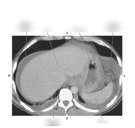 Fig. 7.19 Axial CT Abdomen Diagram | Quizlet