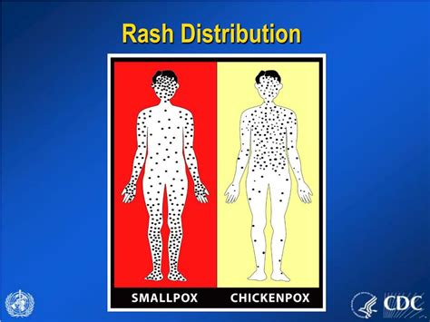 Ppt Evaluating Patients With Acute Generalized Vesicular Or Pustular Rash Illnesses Powerpoint