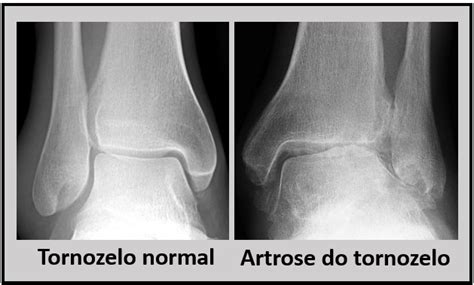 Artrose Do Tornozelo O Que Causa Diagn Stico E Tratamento