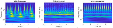 Diagnostics Free Full Text Deep Learning Based Arrhythmia Detection