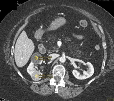 Fatty Replacement Of The Pancreas In Cystic Fibrosis Pancreas Case