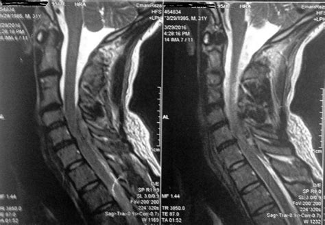 Spinal Epidural Hematoma