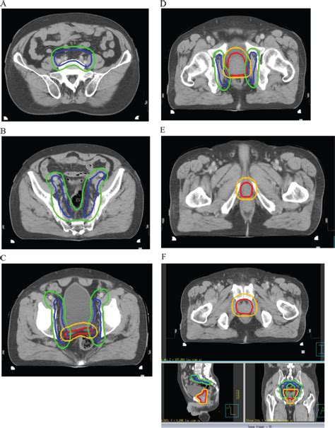 Target Volume Delineation Of Pelvic Lymphatic Drainage And Prostate And Download Scientific