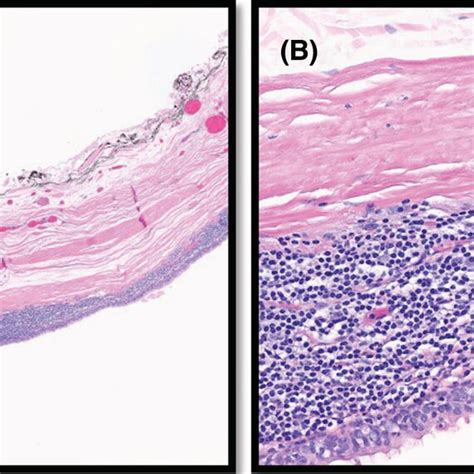 The Low Power Photomicrograph Shows A Cyst Lined With Stratified