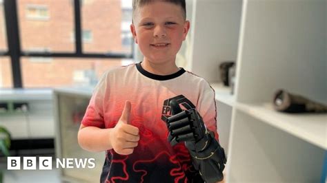 New Bionic Arm Absolutely Life Changing For Boy From Bude