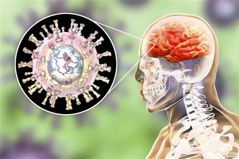 Central Nervous System Infections Pathology Review Osmosis Riset