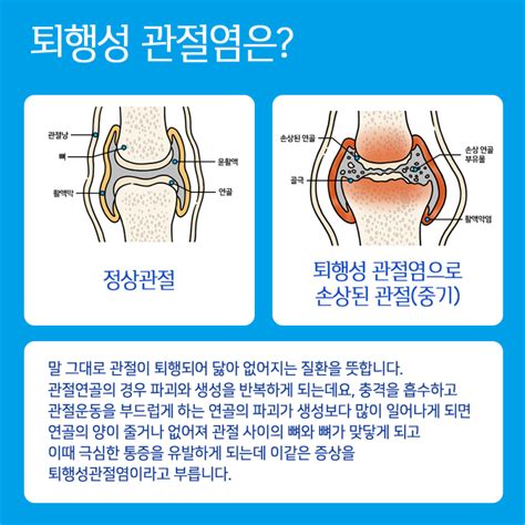 노화의 시작 무릎통증 퇴행성관절염에 좋은것은 속도조절