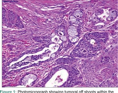 Figure 1 From Epithelial And Stromal Patterns Of Pleomorphic Adenoma Of