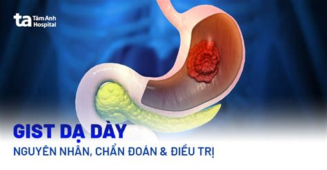 Gist Dạ Dày Nguyên Nhân Triệu Chứng Chẩn đoán Và Phòng Ngừa