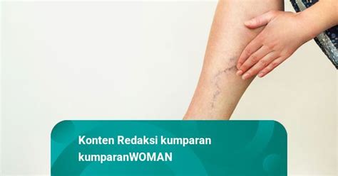 Sering Dialami Perempuan Kenali Penyebab Varises Dan Cara Mengatasinya