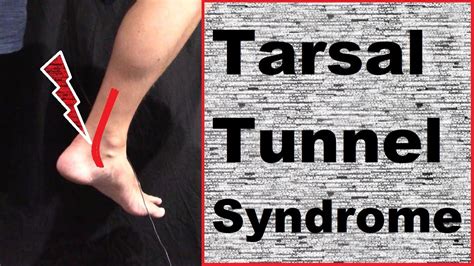 Understanding Treating Tarsal Tunnel Syndrome YouTube