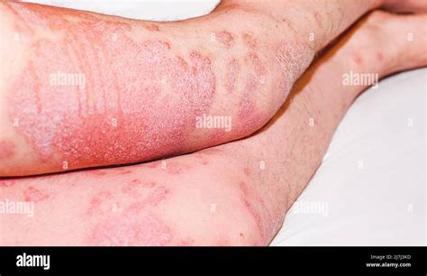 Psoriasis Aguda Fotografías E Imágenes De Alta Resolución Alamy