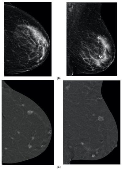 Current Oncology Free Full Text The Impact Of Dense Breasts On The