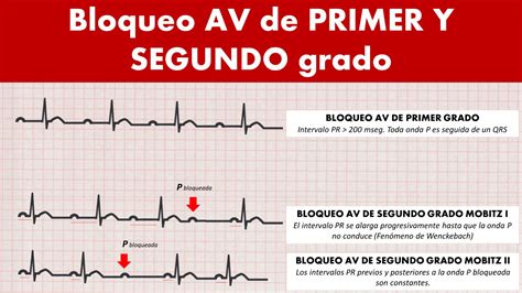 CardioTruco Bloqueos AV Cardioprimaria Ferrol